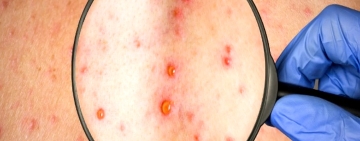 Caso sospechoso de viruela del simio sería más bien varicela