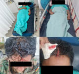 En emboscada cobarde hieren a tres efectivos antidroga en el Chapare