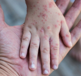 Reportan 74 casos de sarampión: 68 en Santa Cruz, 5 en La Paz y 1 en Potosí