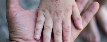 Reportan 74 casos de sarampión: 68 en Santa Cruz, 5 en La Paz y 1 en Potosí