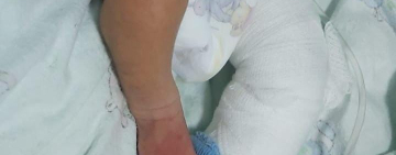 Recién nacido sufre quemaduras y Fiscalía investiga contra implicados