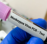 En Santa Cruz confirman dos casos de viruela símica y cuatro sospechosos y el Sedes intensifica vigilancia epidemiológica