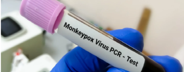 En Santa Cruz confirman dos casos de viruela símica y cuatro sospechosos y el Sedes intensifica vigilancia epidemiológica