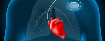 Lanzan campaña en Cochabamba para colocar 60 marcapasos gratuitos a pacientes